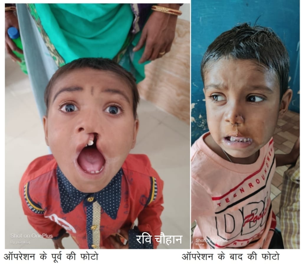 ग्राम सातउमरी में बच्चे के होठ के सर्जरी का उपचार